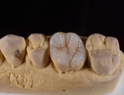 The Benefits of IPS e.max® Crowns