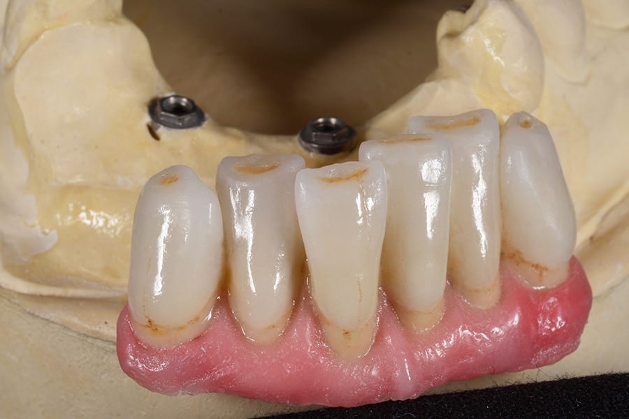 Dental Implant